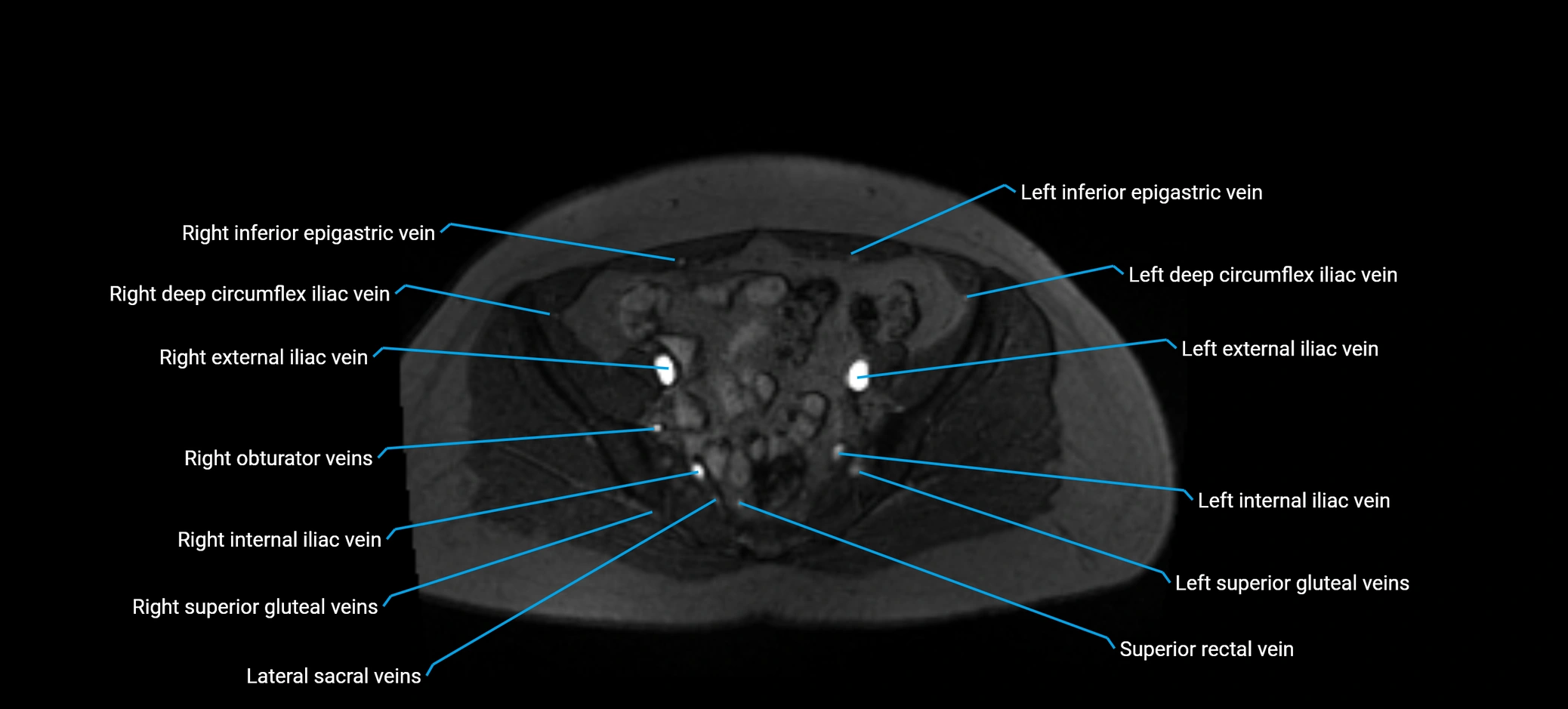 MRV abdomen pelvis & lower limb axial cross sectional anatomy labelled MRI image 148 (1).webp